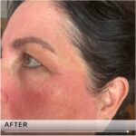 Plasma facial treatment for skin aesthetics. Non invasive Skin tightening & wrinkles reverse, offering a non-surgical face-lift and rejuvenated face. Botox alterantive.