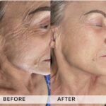 Plasma facial treatment for skin aesthetics. Non invasive Skin tightening & wrinkles reverse, offering a non-surgical face-lift and rejuvenated face. Botox alterantive.