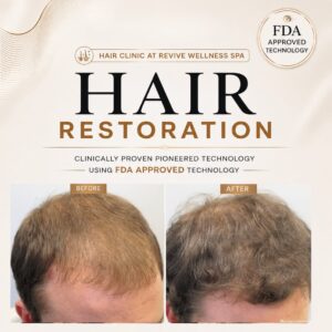 Hair Clinic: Clinically proven, non-invasive hair growth treatment for hair loss, hair thinning & balding. HAIR RESTORATION without a hair transplant. Plasma