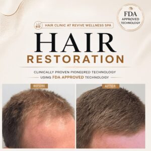Hair Clinic: Clinically proven, non-invasive hair growth treatment for hair loss, hair thinning & balding. HAIR RESTORATION without a hair transplant. Plasma