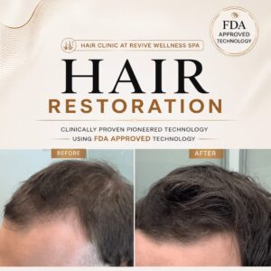 Hair Clinic: Clinically proven, non-invasive hair growth treatment for hair loss, hair thinning & balding. HAIR RESTORATION without a hair transplant. Plasma
