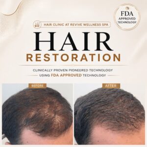 Hair Clinic: Clinically proven, non-invasive hair growth treatment for hair loss, hair thinning & balding. HAIR RESTORATION without a hair transplant. Plasma