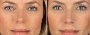 hyaluronic filler for smile lines
