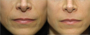 hyaluronic filler for smile lines