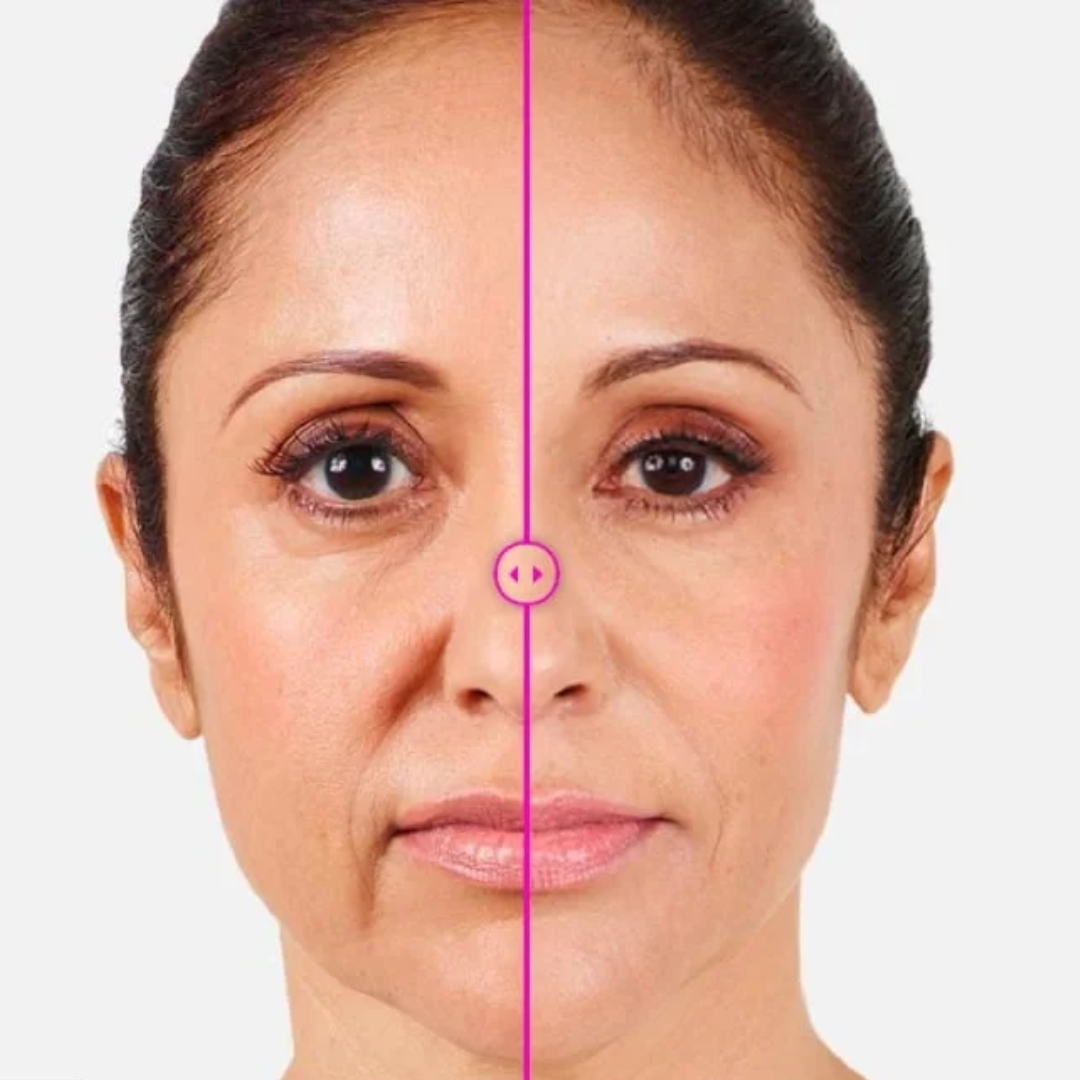 hyaluronic filler for lip plumping